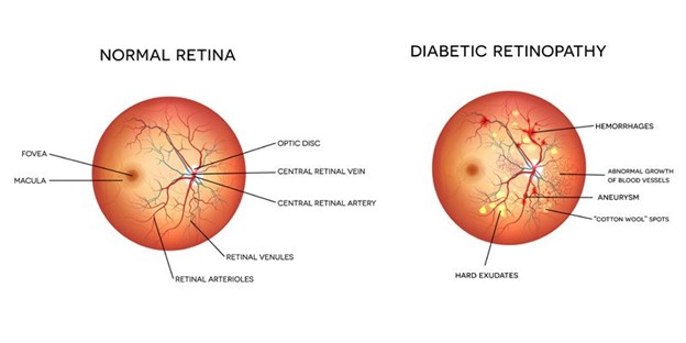 diabetes diabetic photo